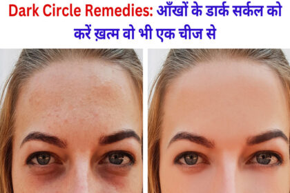Dark Circle Remedies